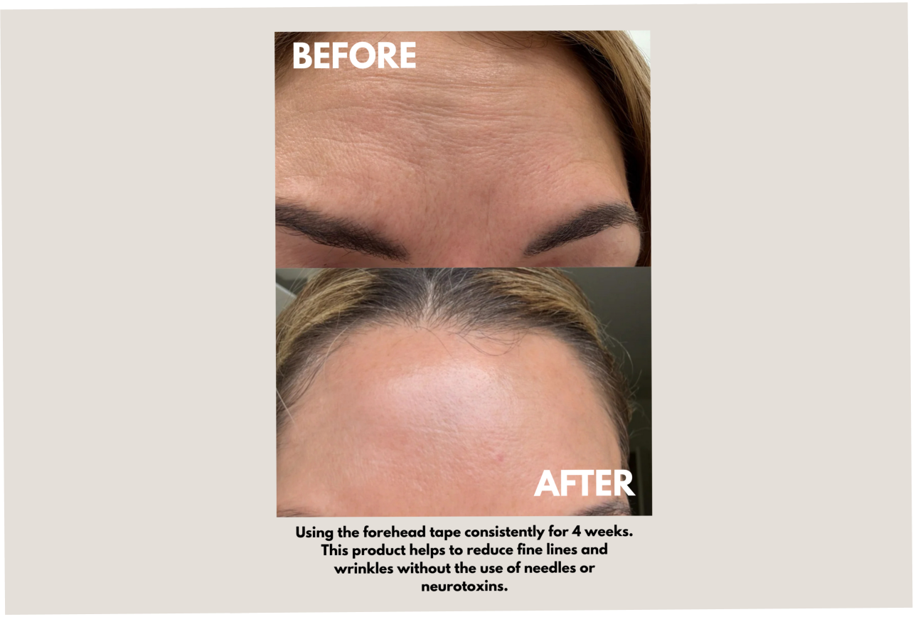 Seald™ Forehead Tape – Wrinkle Smoothing Patches