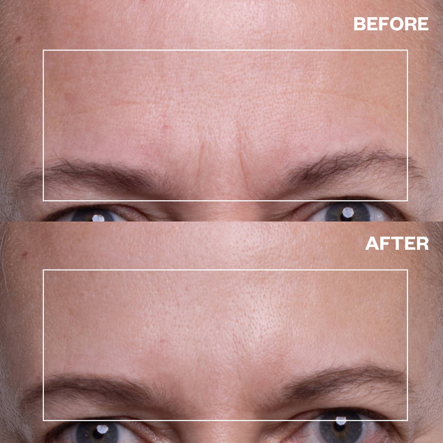 Forehead Wrinkle Patch