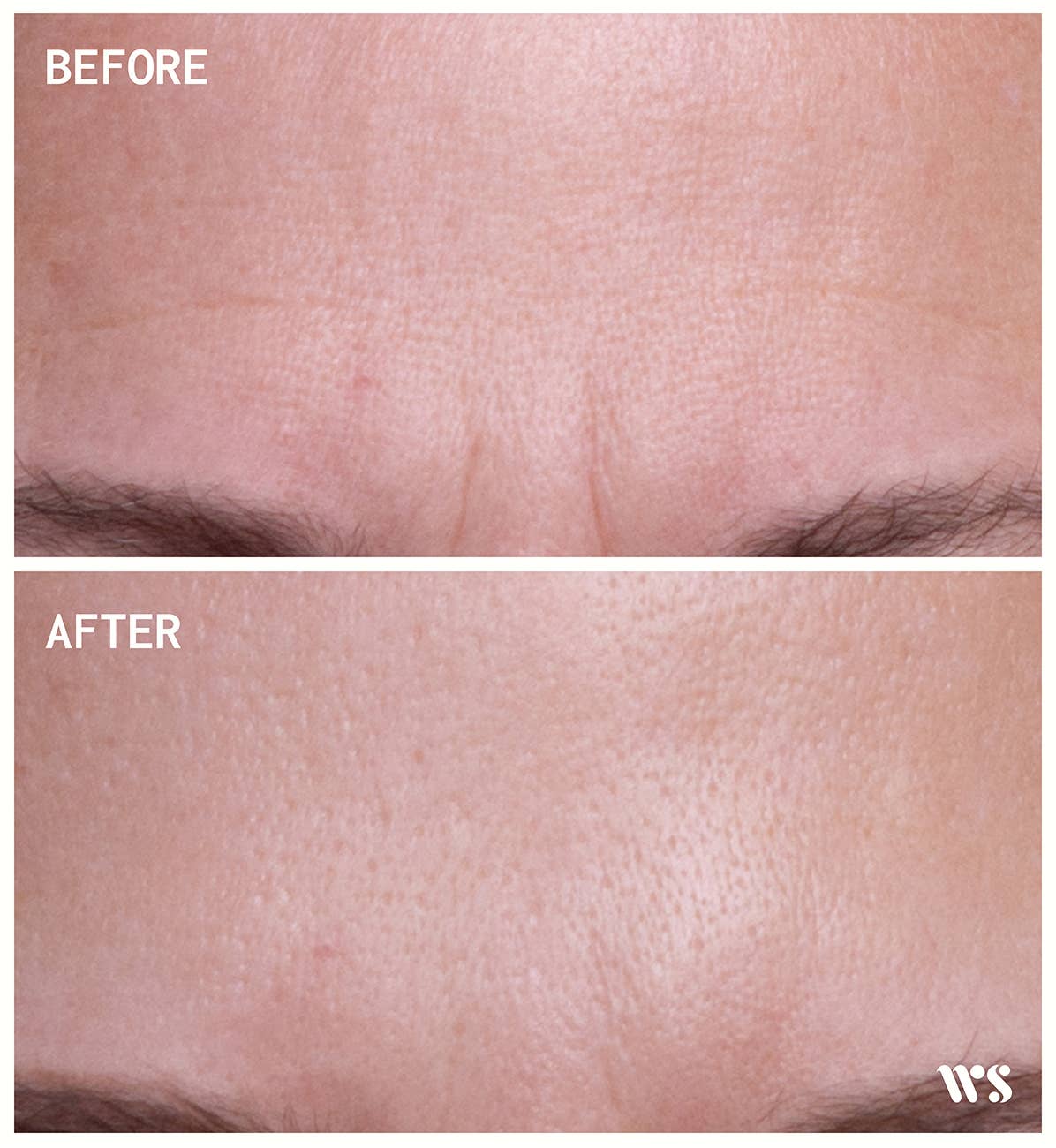 Brow Frown & Bunny Lines Wrinkle Patches (2 count)